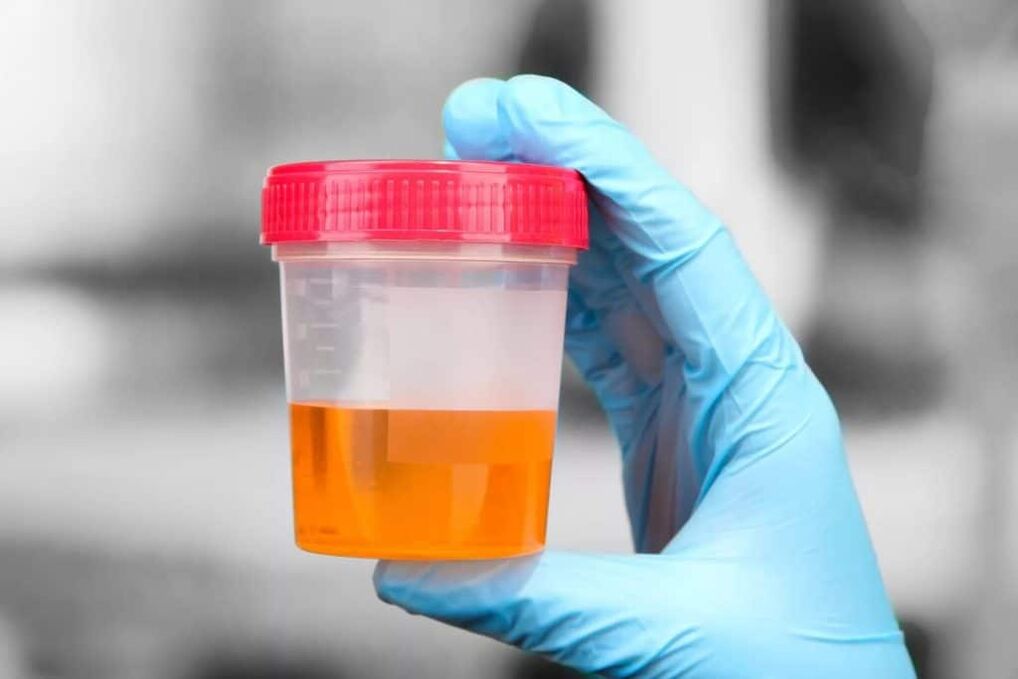 urine met bloed bij calculous prostatitis
