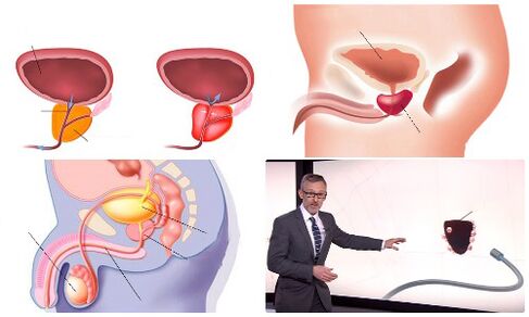 gezonde en zieke prostaat